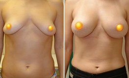 Фото до и после пластики груди из периареолярного доступа имплантатами объемом 355 мл
