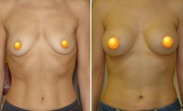 Фото до и после пластики по увеличению груди из периареолярного доступа имплантатами