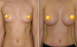 Фото до и после увеличения груди из подмышечного доступа имплантатами объемом 275 мл