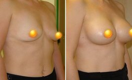 Фото до и после маммопластики имплантатами объемом 380 мл разрезом по ареоле