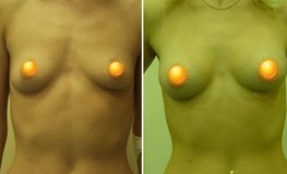 Фото до и после увеличения груди из субмаммарного доступа имплантатами 195 мл
