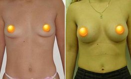 Фото до и после увеличения груди из субмаммарного доступа имплантатами объемом 305 мл