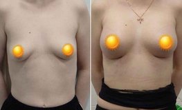 Фото до и после увеличения груди из субмаммарного доступа имплантатами объемом 245 мл
