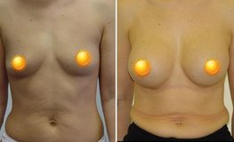 Фото до и после увеличения груди из субмаммарного доступа имплантатами объемом 320 мл