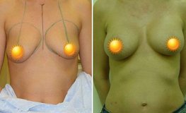 Фото до и после увеличения груди из субмаммарного доступа имплантатами объемом 210 мл