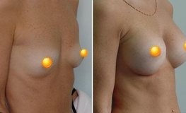 Фото до и после увеличения груди из субмаммарного доступа имплантатами объемом 420 мл