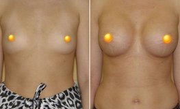Фото до и после увеличения груди из подмышечного доступа имплантатами объемом 395 мл