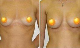 Фото до и после увеличения груди из субмаммарного доступа имплантатами объемом 225 мл
