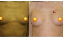 Фото до и после увеличения груди из субмаммарного доступа имплантатами объемом 125 мл