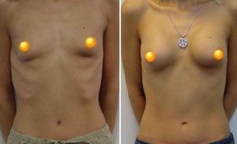 Фото до и после увеличения груди из субмаммарного доступа имплантатами объемом 215 мл