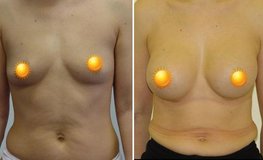 Фото до и после увеличения груди из субмаммарного доступа имплантатами объемом 310 мл