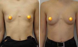 Фото до и после увеличения груди при аномалиях развития имплантатами объемом 195 мл