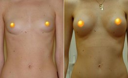 Фото до и после увеличения груди из подмышечного доступа имплантатами объемом 225 мл