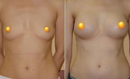 Фото до и после увеличения груди из подмышечного доступа имплантатами объемом 325 мл
