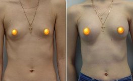 Фото до и после увеличения груди из подмышечного доступа имплантатами объемом 240 мл
