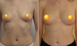 Фото до и после увеличения груди из подмышечного доступа имплантатами объемом 290 мл
