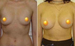 Фото до и после увеличения груди из подмышечного доступа имплантатами объемом 315 мл