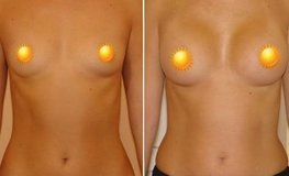 Фото до и после увеличения груди из подмышечного доступа имплантатами объемом 255 мл