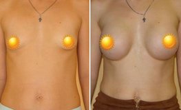 Фото до и после увеличения груди из подмышечного доступа имплантатами объемом 375 мл