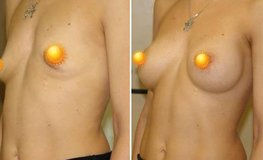 Фото до и после увеличения груди из подмышечного доступа имплантатами объемом 400 мл