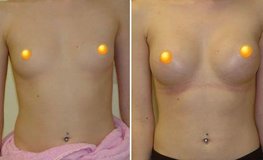 Фото до и после увеличения груди из подмышечного доступа имплантатами объемом 260 мл