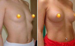 Фото до и после увеличения объема груди из подмышечного доступа имплантатами
