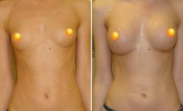 Фото до и после увеличения объема груди из подмышечного доступа имплантатами 305 мл