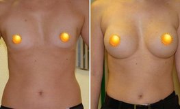 Фото до и после увеличения груди разрезом под мышкой имплантатами объемом 405 мл