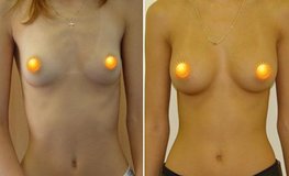 Фото до и после увеличивающей пластики груди из подмышечного доступа 
