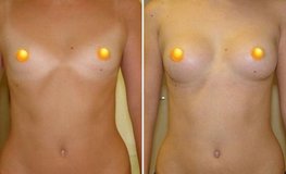 Фото до и после увеличения груди из подмышечного доступа имплантатами объемом 205 мл