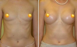 Фото до и после увеличения груди имплантатами объемом 390 мл из подмышечного доступа