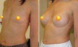 Фото до и после увеличения груди имплантатами объемом 375 мл из подмышечного доступа 