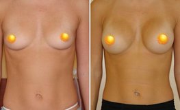 Фото до и после увеличения груди из периареолярного доступа имплантатами 205 мл