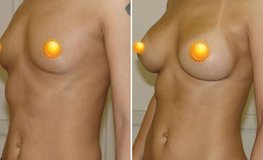 Фото до и после увеличения груди имплантатами 375 мл разрезом по ареоле