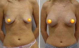 Фото до и после увеличения груди из периареолярного доступа круглыми имплантатами