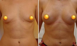 Фото до и после увеличения груди имплантатами объемом 330 мл разрезом по ареоле