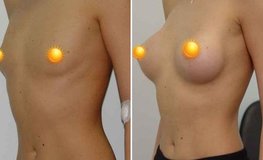Фото до и после увеличение груди из периареолярного доступа имплантатами круглой формы