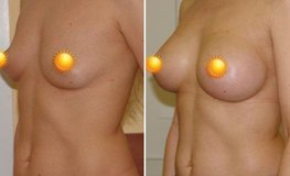 Фото до и после увеличения груди из периареолярного доступа имплантатами 375 мл