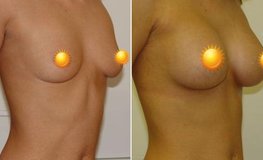 Фото до и после увеличения груди из подмышечного доступа 