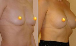Фото до и после увеличения груди из периареолярного доступа имплантатами 395 мл