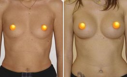 Фото до и после маммопластики из периареолярного доступа имплантатами объемом 315 мл