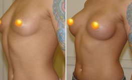 Фото до и после маммопластики из периареолярного доступа имплантатами круглой формы