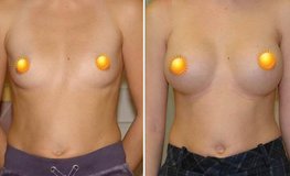 Фото до и после пластики груди из периареолярного доступа имплантатами объемом 390 мл