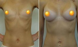 Фото до и после увеличения груди из подмышечного доступа имплантатами объемом 420 мл