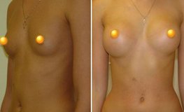 Фото до и после увеличивающей маммопластики из подмышечного доступа