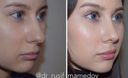 Фото до и после динамичной риноскульптуры носа с сохранением целостности связок