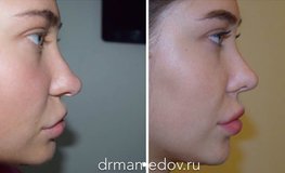 Фото до и после малотравматичной методики динамичная риноскульптура носа
