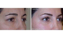 Фото до и после серии операций для зоны глаз