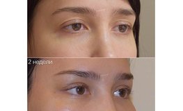Фото до и после комплекса эндоскопических операций по подтяжке лицевых зон