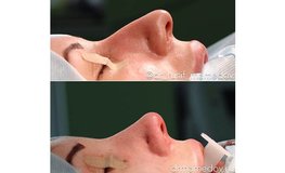 Фото до и после атравматичной методики динамичной риноскульптуры носа
